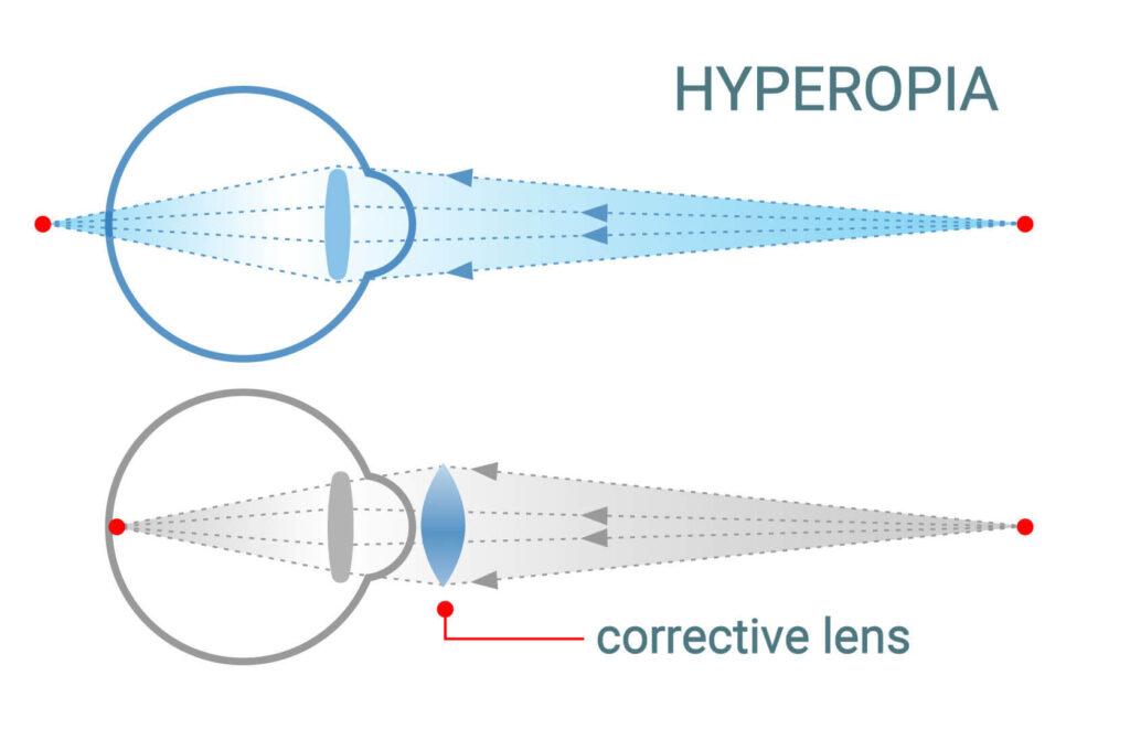 viewpoint eye test farsighted