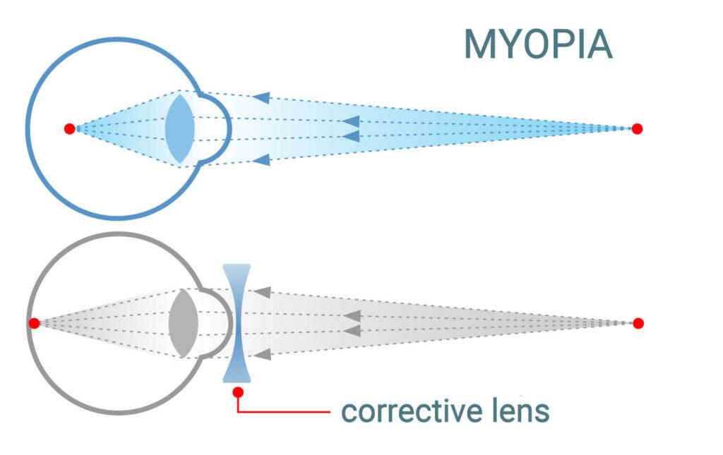 viewpoint shortsighted eye test