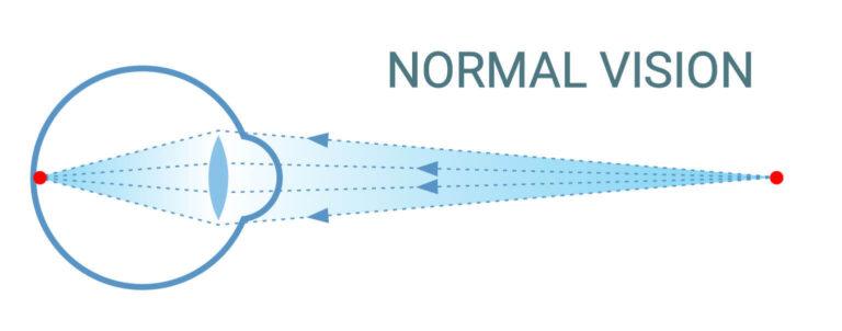 optometrist normal vision