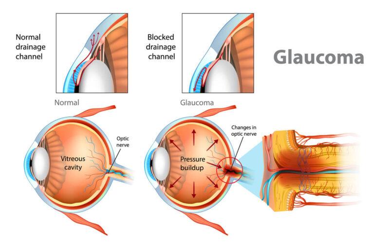 Optometrist Glaucoma test