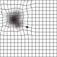 Abnormal Amsler Grid